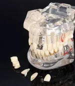 Dental Restoration with implant all in one model - Image 2