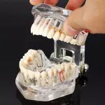 Dental Restoration with implant all in one model
